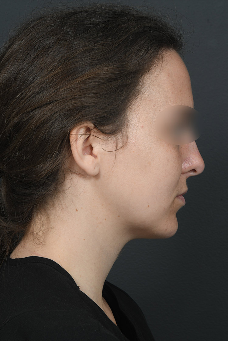 Female face, after BUCCAL FAT REMOVAL treatment, r-side view, patient 2