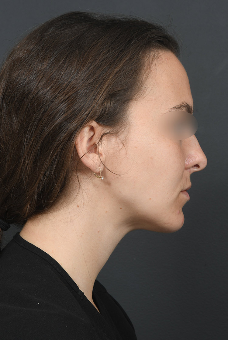 Female face, before BUCCAL FAT REMOVAL treatment, r-side view, patient 2