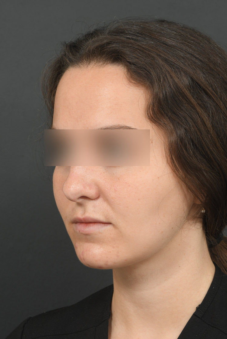 Female face, after BUCCAL FAT REMOVAL treatment, l-side oblique view, patient 2