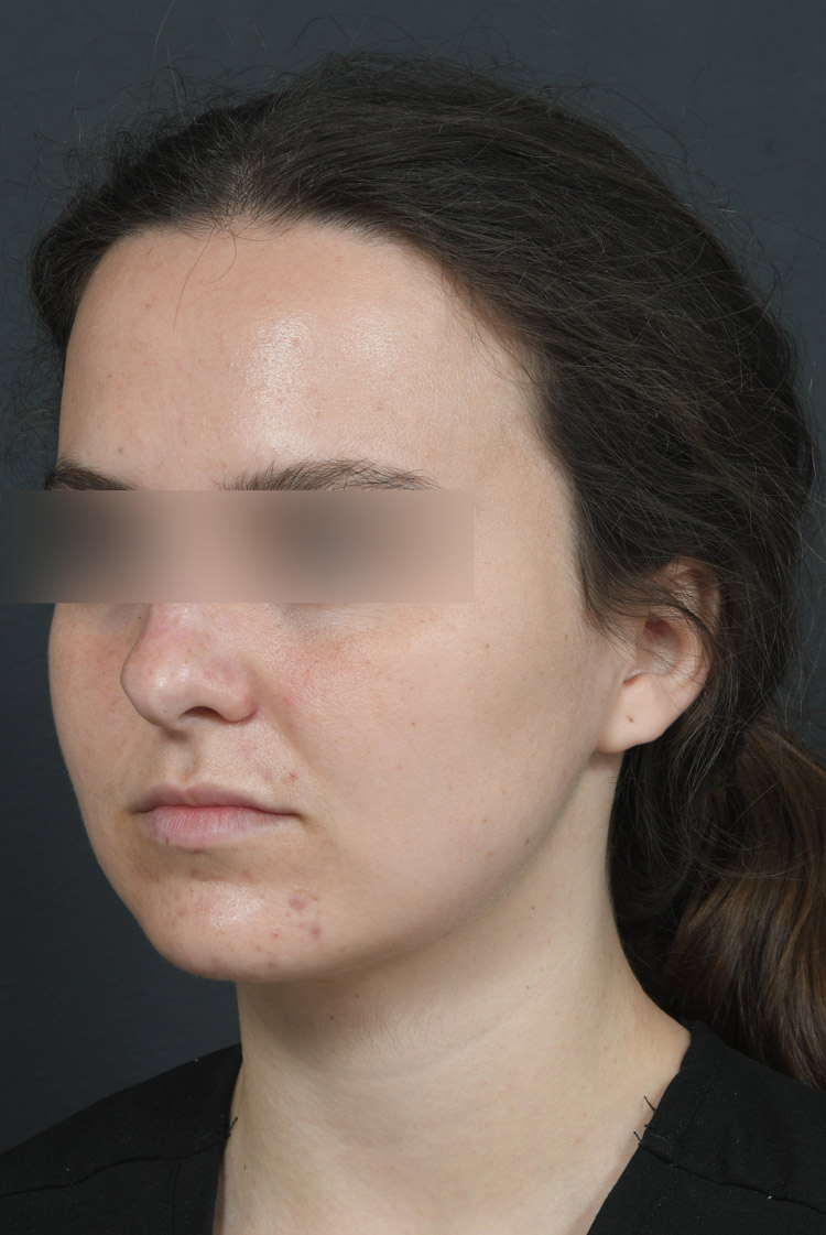 Female face, before BUCCAL FAT REMOVAL treatment, l-side oblique view, patient 2