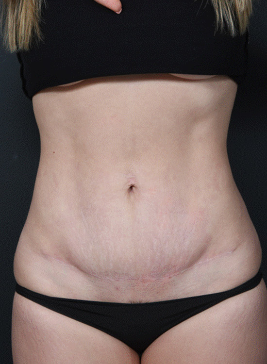 Female body, after tummy tuck treatment, front view, patient 15