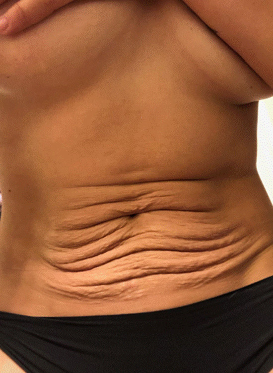 Female body, before tummy tuck treatment, front view, patient 15