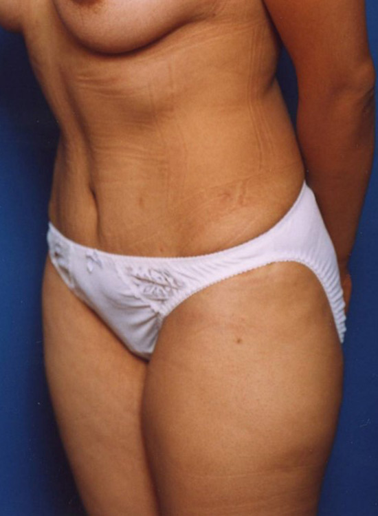 Female body, after tummy tuck treatment, oblique view, patient 16