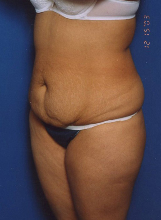 Female body, before tummy tuck treatment, oblique view, patient 16