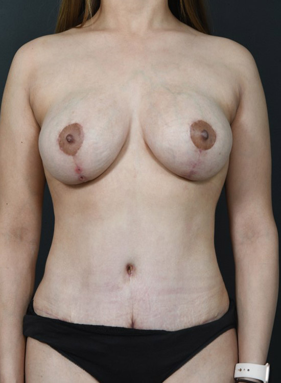 Female body, after tummy tuck treatment, front view, patient 17