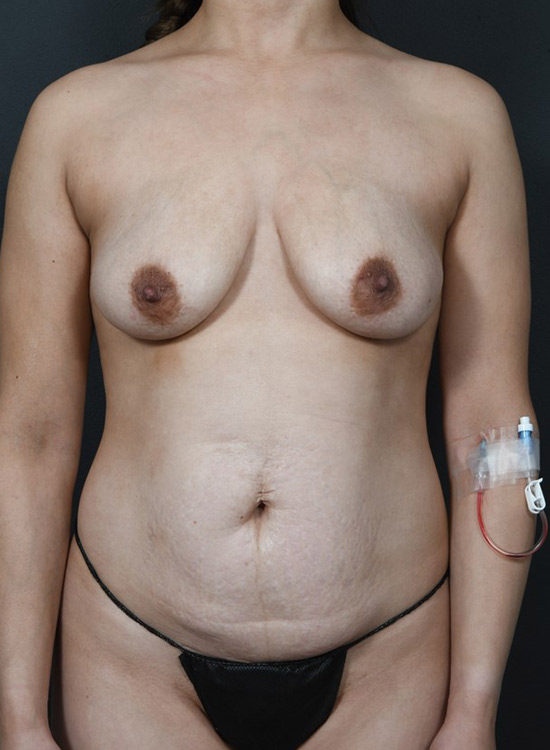 Female body, before tummy tuck treatment, front view, patient 17