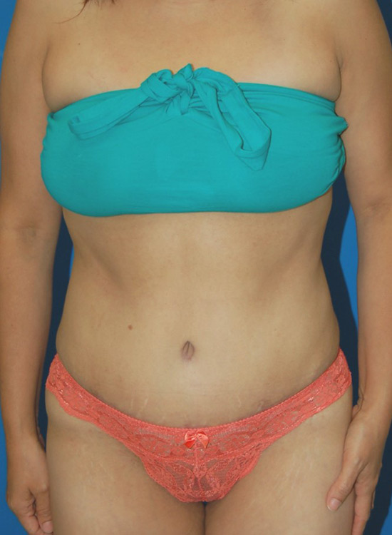 Female body, after tummy tuck treatment, front view, patient 18