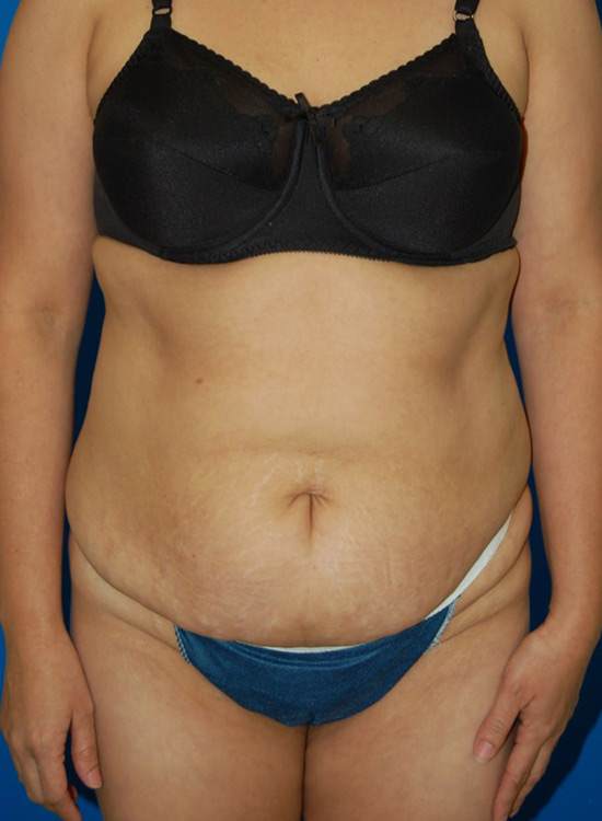Female body, before tummy tuck treatment, front view, patient 18