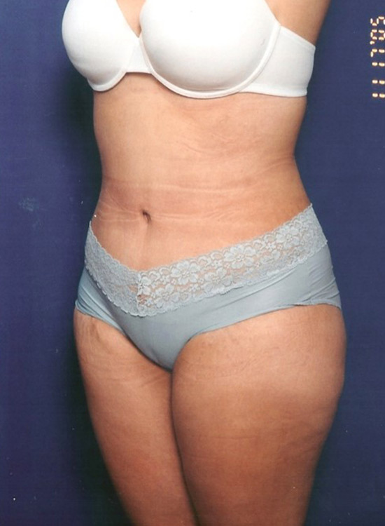 Female body, after tummy tuck treatment, front view, patient 20