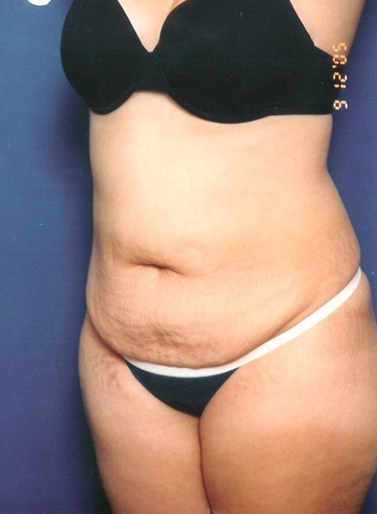 Female body, before tummy tuck treatment, front view, patient 20