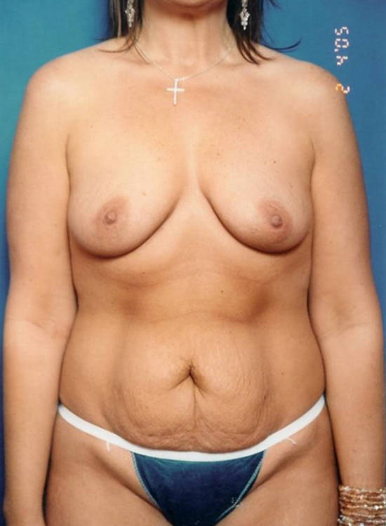 Female body, before tummy tuck treatment, front view, patient 22