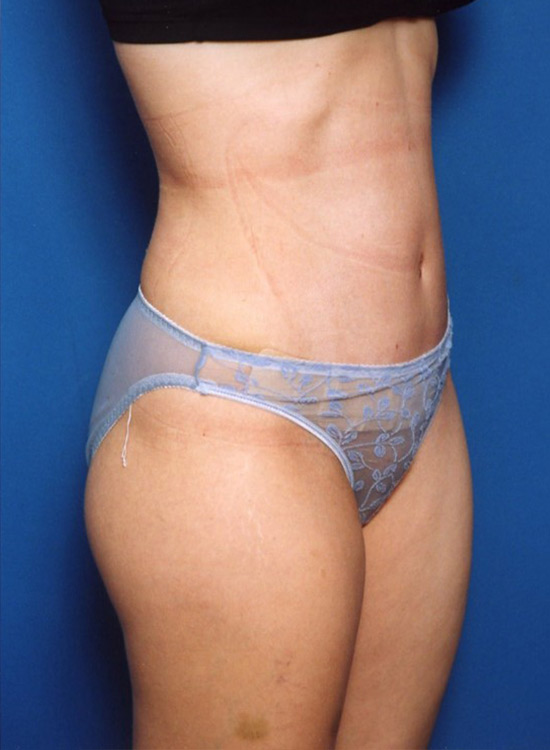 Female body, after tummy tuck treatment, oblique view, patient 23
