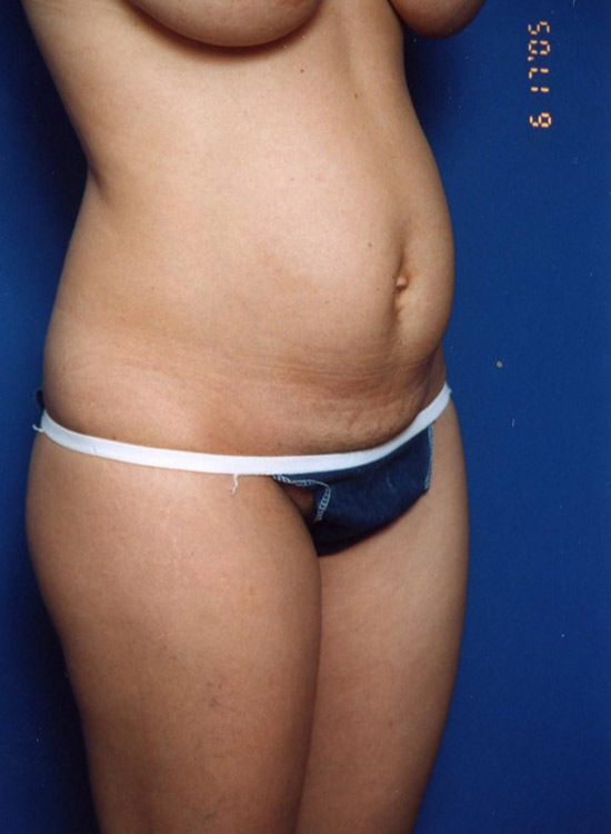 Female body, before tummy tuck treatment, oblique view, patient 23
