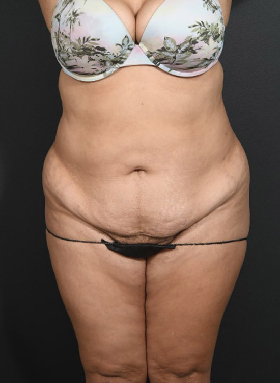 Female body, before tummy tuck treatment, front view, patient 24