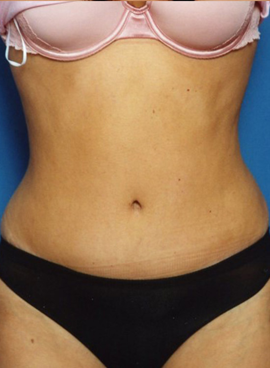 Female body, after tummy tuck treatment, front view, patient 26
