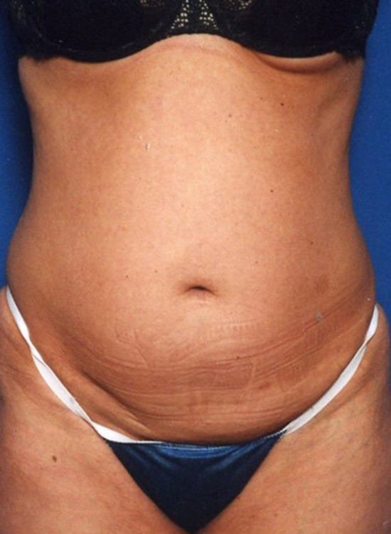 Female body, before tummy tuck treatment, front view, patient 26