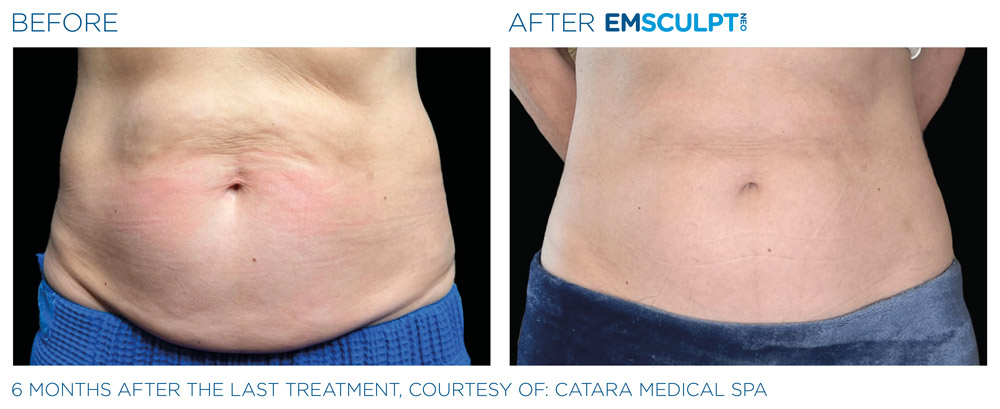 Emsculpt neo patient before and after photo 1