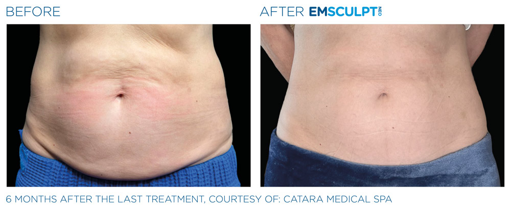 Emsculpt Neo  Body Toning In Los Angeles