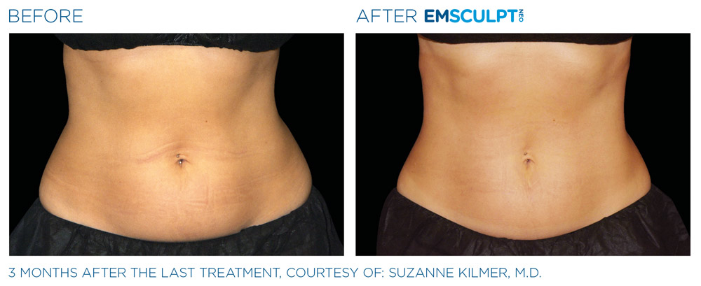 Emsculpt neo patient before and after photo 2