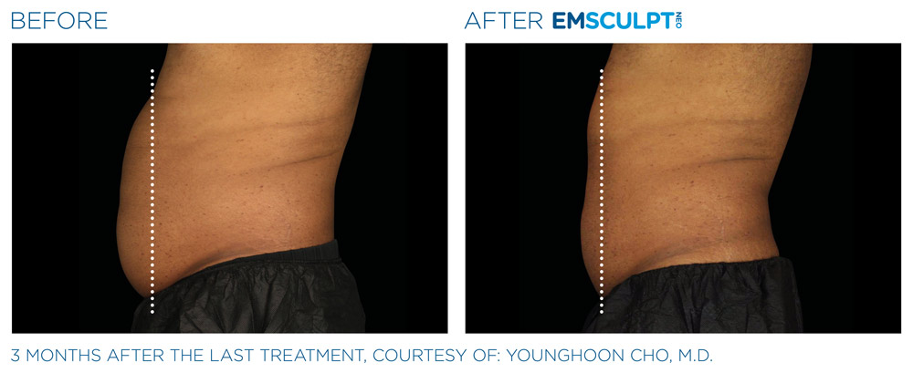 Emsculpt neo patient before and after photo 4