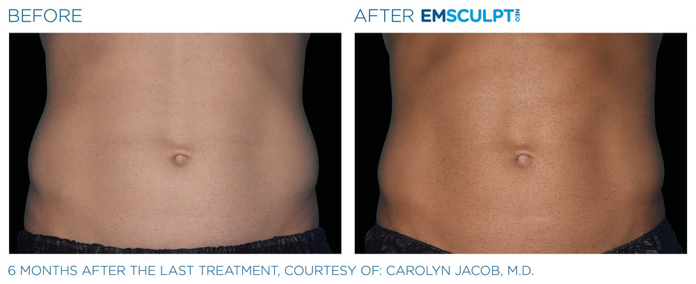 Emsculpt Neo  Body Toning In Los Angeles