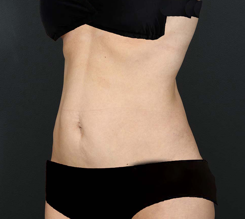 Actual tummy tuck woman patient before photo