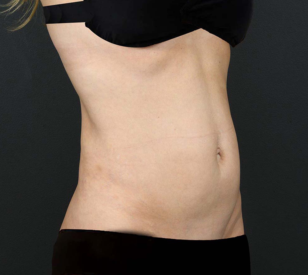 Actual tummy tuck woman patient before photo