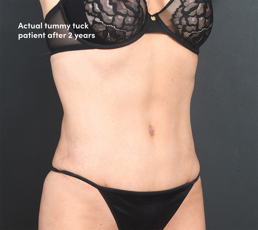 Actual tummy tuck woman patient after photo