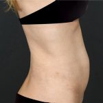 Thumbnail Photo Actual tummy tuck woman patient right side before photo