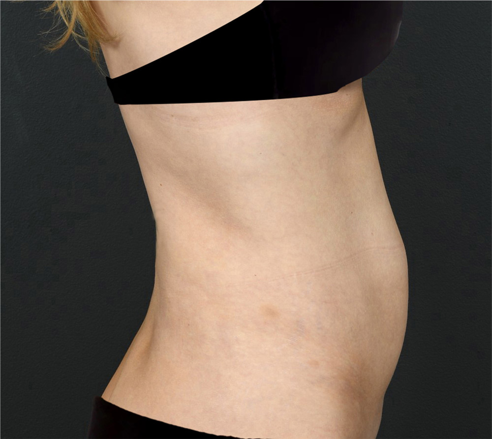 Actual tummy tuck woman patient right side before photo