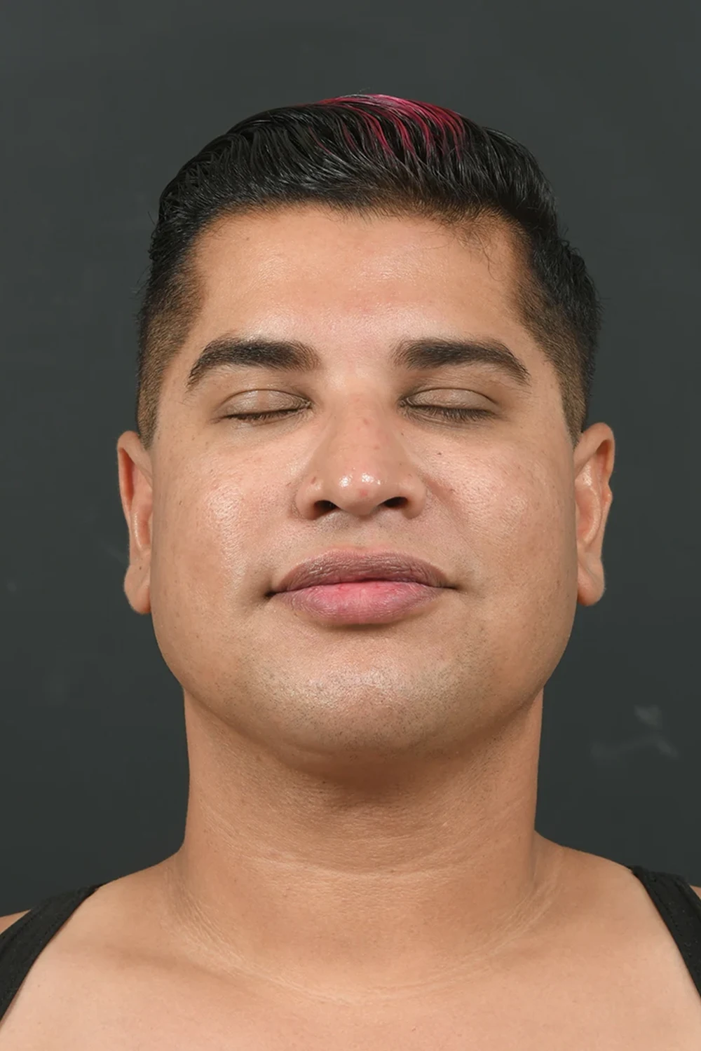 Liposuction man patient after front photo