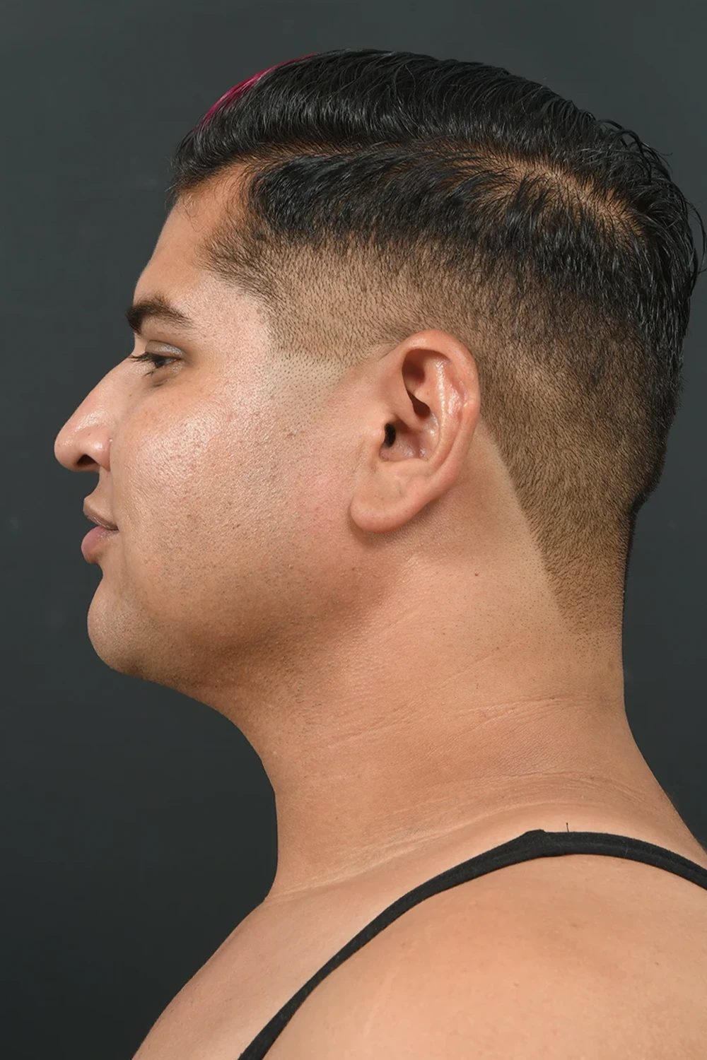 Liposuction man patient after photo