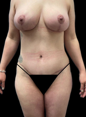 Breast Augmentation: Case 38 Front After