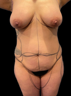 Breast Augmentation: Case 38 Front Before