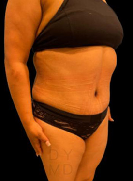 Left oblique After