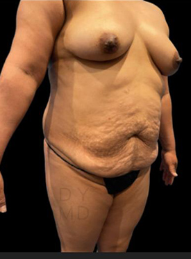 Left oblique before
