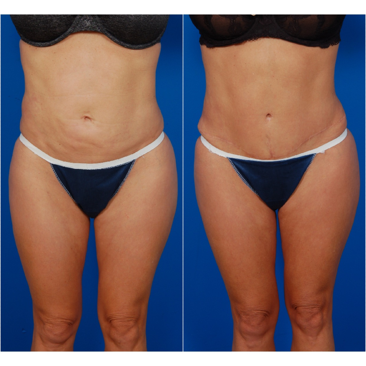 Woman's body, before and after liposuction revision surgery, front view