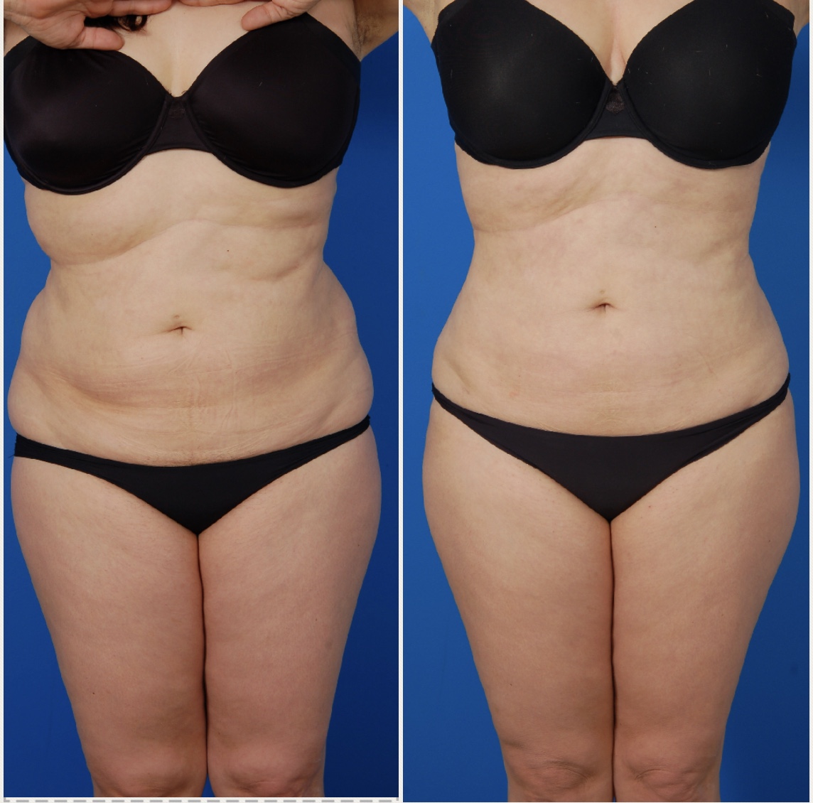 Woman's body, before and after Liposuction Revision Surgery, front view, patient 1