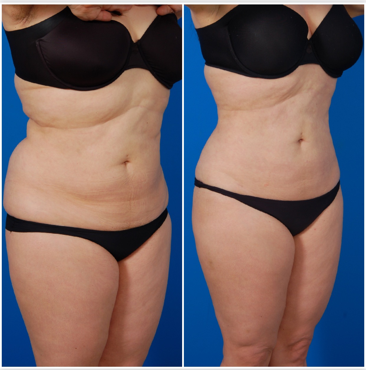 Woman's body, before and after Liposuction Revision Surgery, r-side oblique view, patient 1