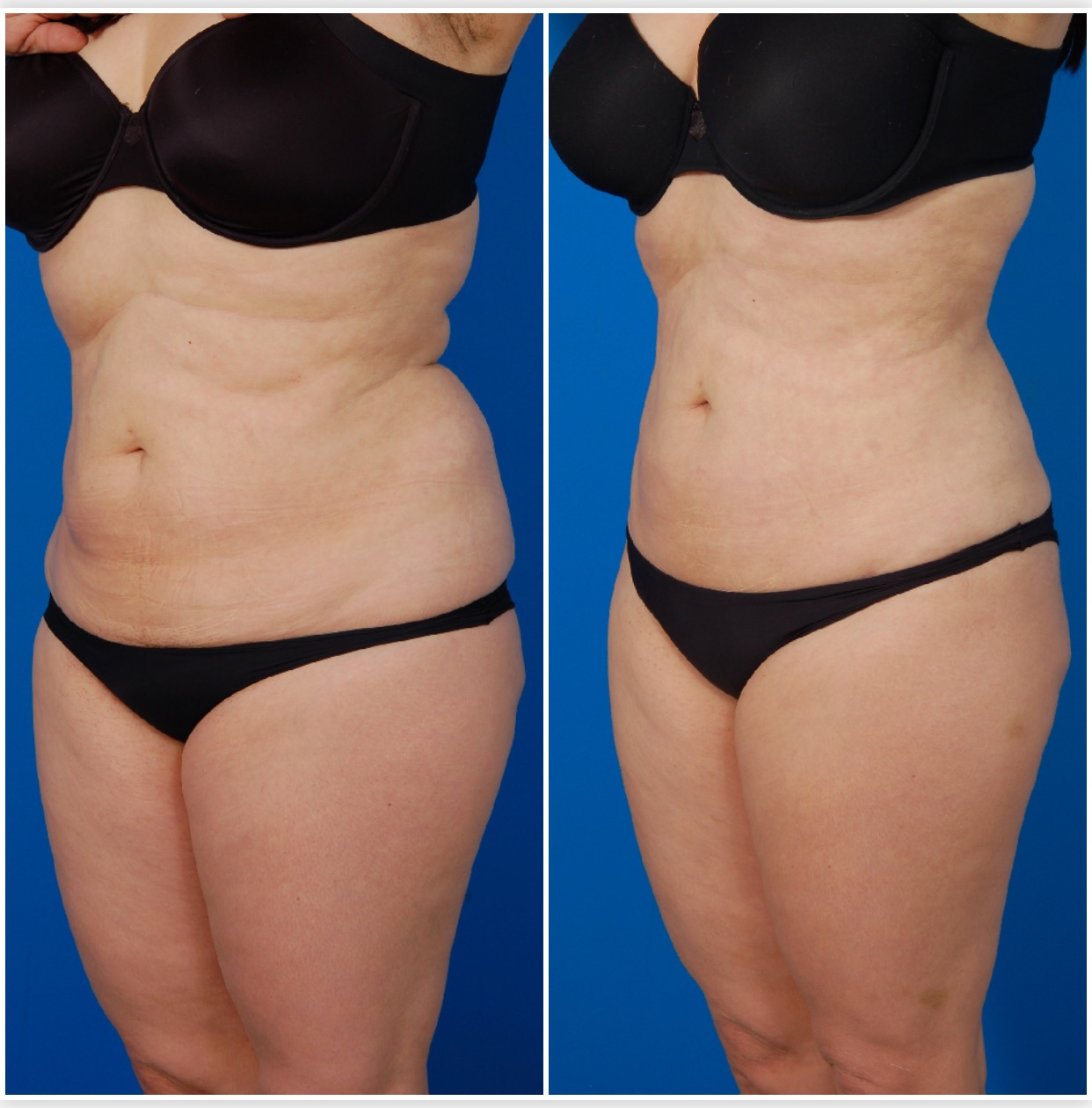 Woman's body, before and after Liposuction Revision Surgery, l-side oblique view, patient 1
