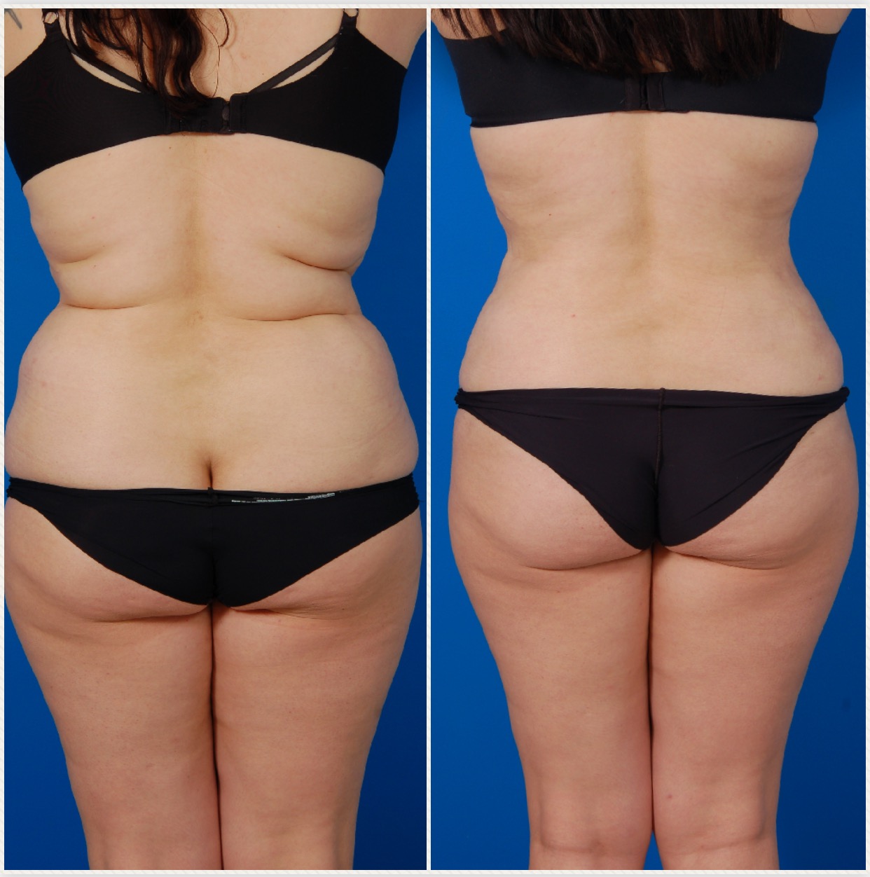 Woman's body, before and after Liposuction Revision Surgery, back view, patient 1
