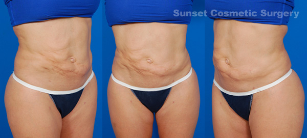 Female body, before liposuction revision treatment, front view