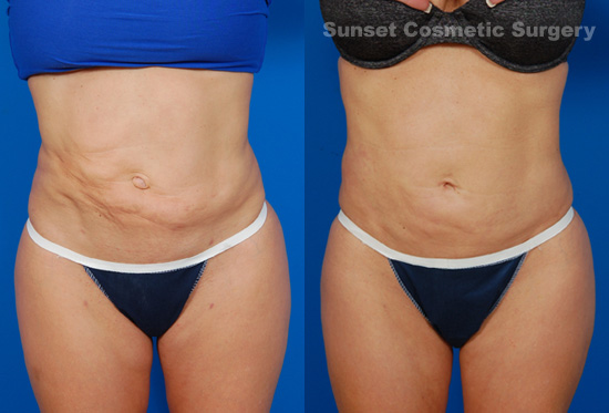 Female body, before and after liposuction revision treatment, front view