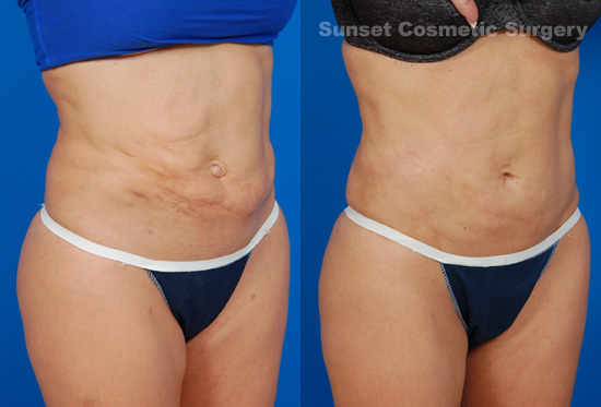 Female body, before and after liposuction revision treatment, r-side oblique view