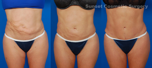 Female body, before and after 2 liposuction revision treatments, front view