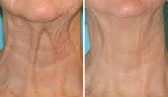 Female neck, before and after botox treatment, front view