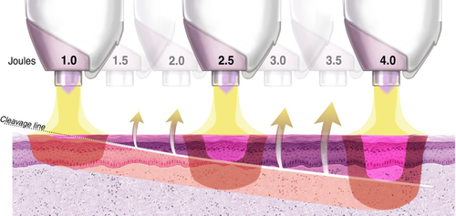 Portrait Plasma Skin Regeneration - schema