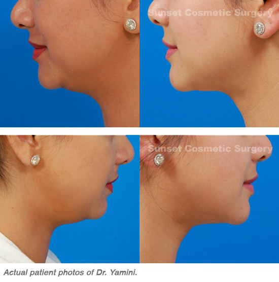 Female face, before and after kybella treatment, side view